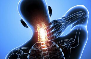 Osteocondrose cervical