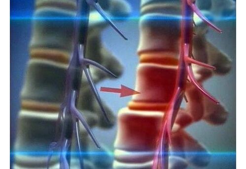 Apertura das terminacións nerviosas na osteocondrose lumbar