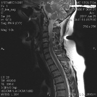 Osteocondrose e espondilose da columna cervical