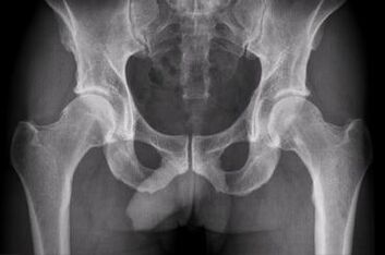Opcións de diagnóstico para a artrose da articulación da cadeira