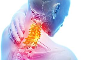 Os principais signos e síntomas da osteocondrose cervical