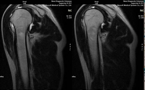 radiografía para diagnosticar a artrose do ombreiro